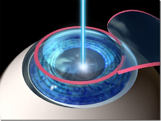 LASIK surgery in Nashik