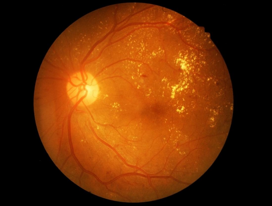 Diabetic retinopathy and vitreo-retinal services in Nashik